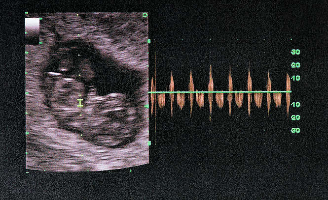 Iowa : pas d’avortement si le cœur du bébé bat