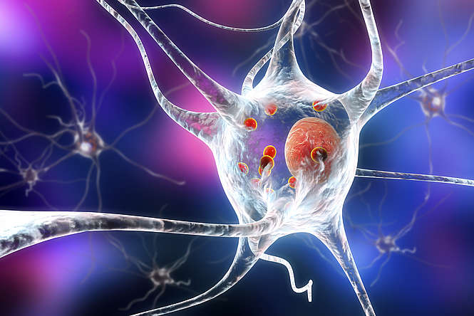 Parkinson : des cellules transplantées directement dans le cerveau contre la maladie