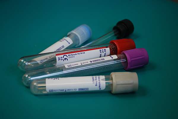 Un simple test sanguin pour détecter la maladie d’Alzheimer